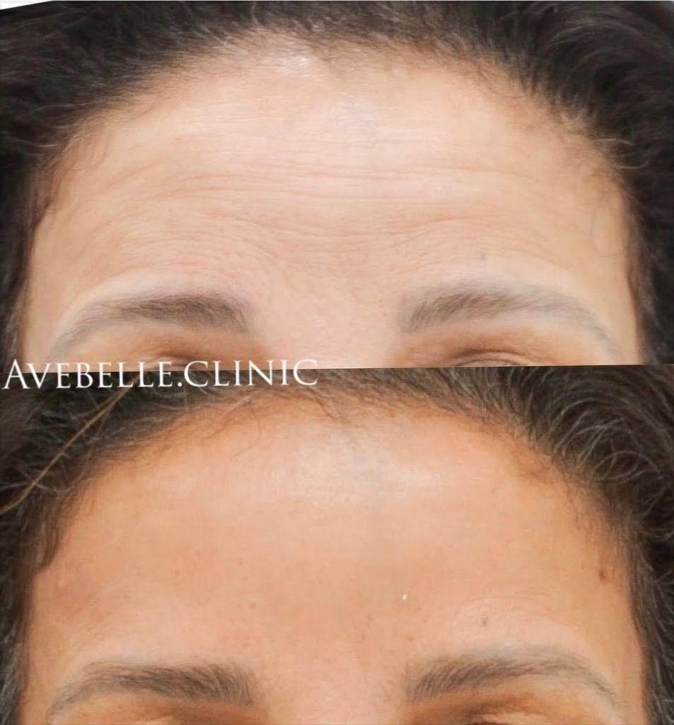 Botox Case 1 