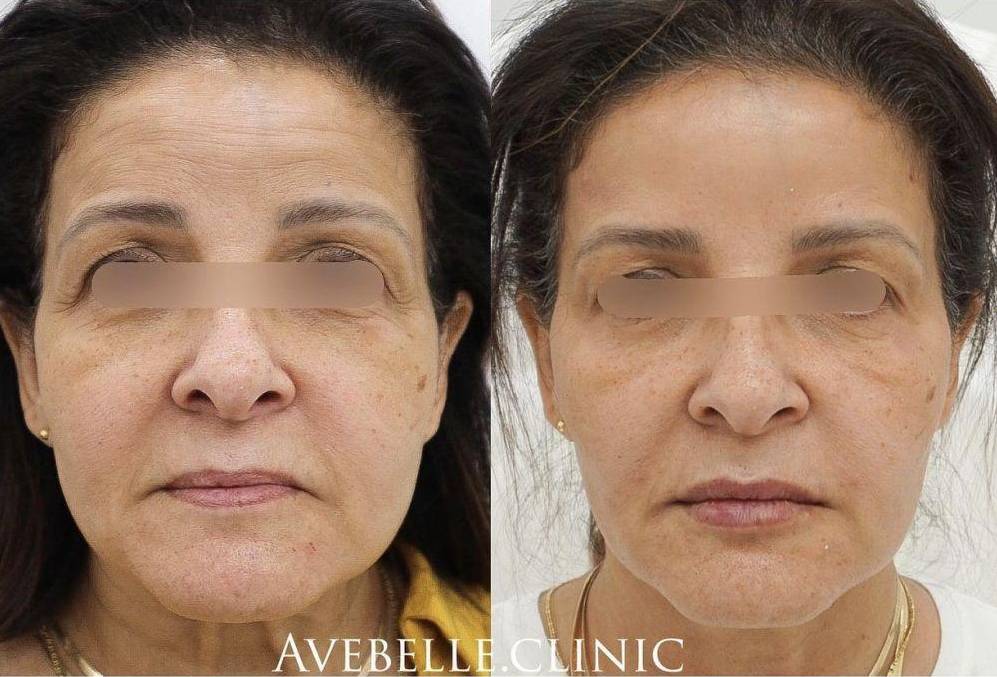 Botox Case 2 