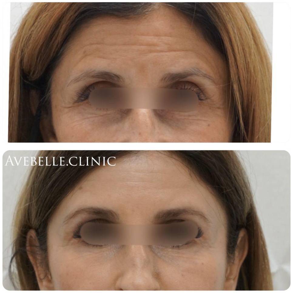 Botox Case 5 