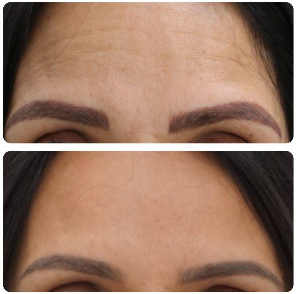 Botox Case 6 