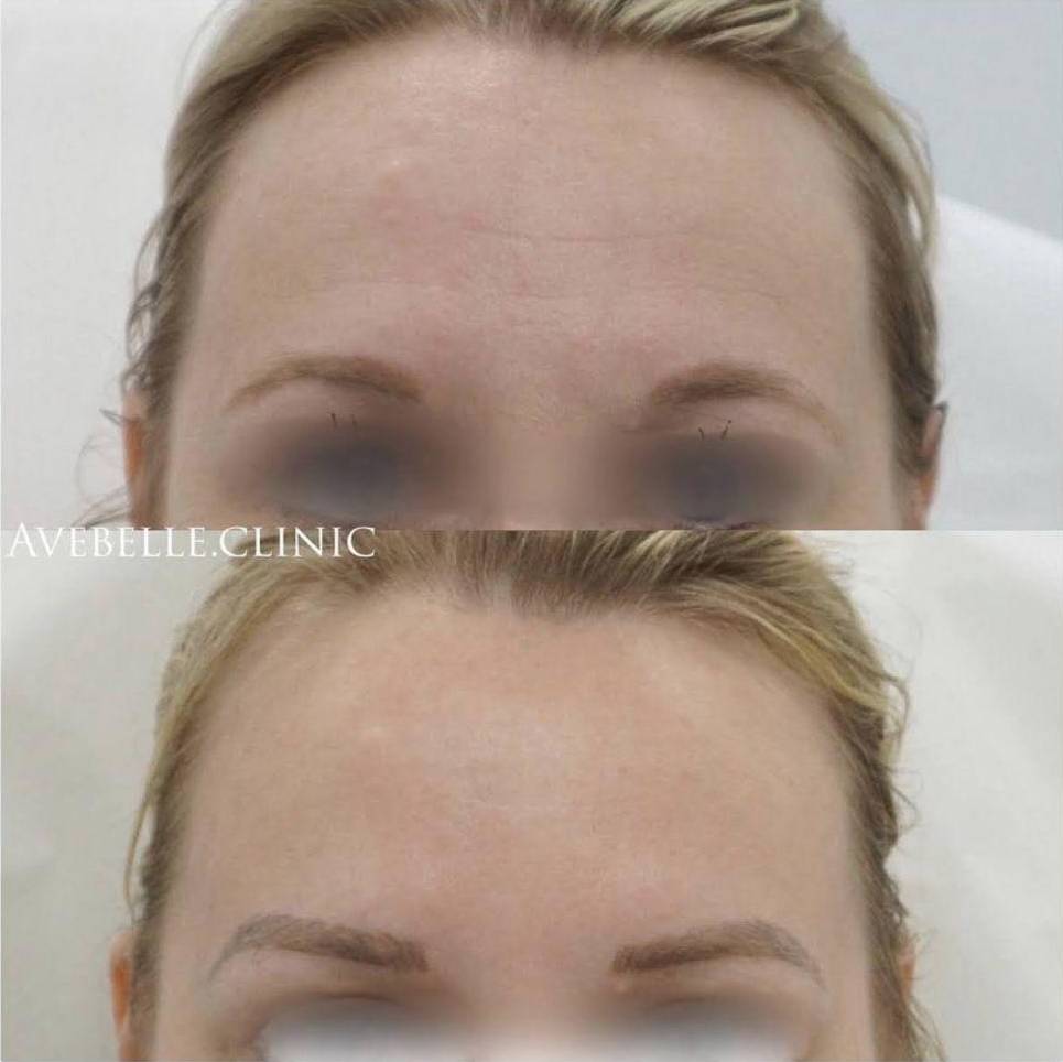 Botox Case 7 