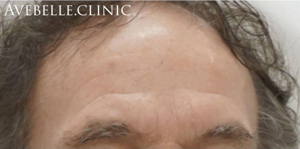 Botox Case 8 After