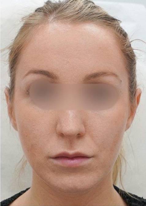 Face Slimming Case 01 After