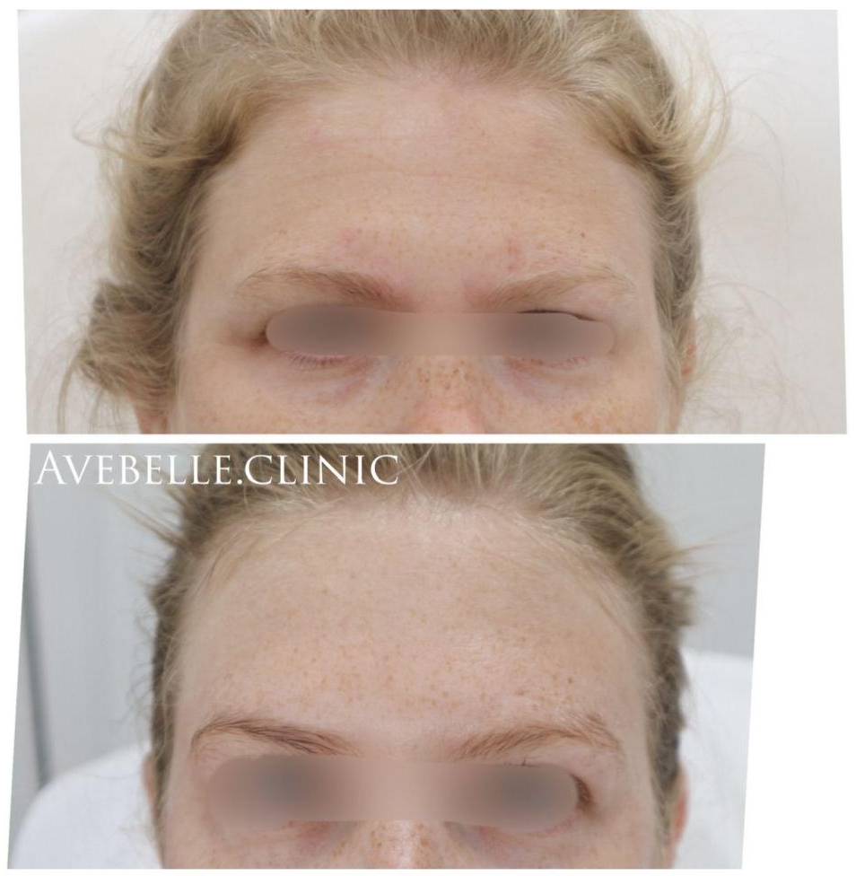 Botox Case 9 