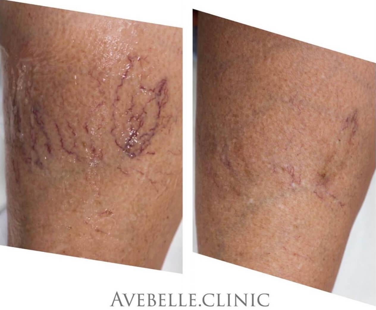 Vein Removal Case 01 
