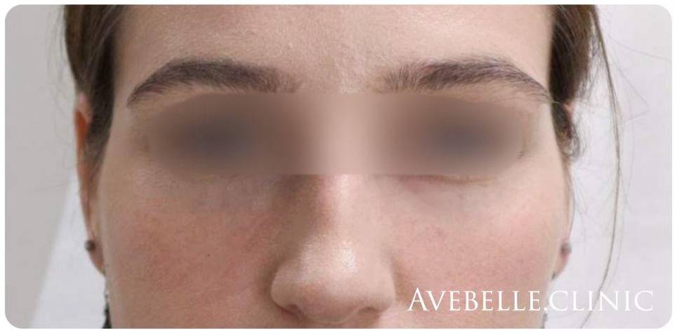 Undereyes Case 3 After