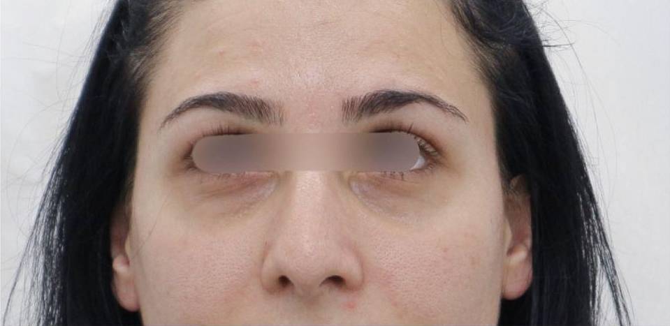 Undereyes Case 5 Before