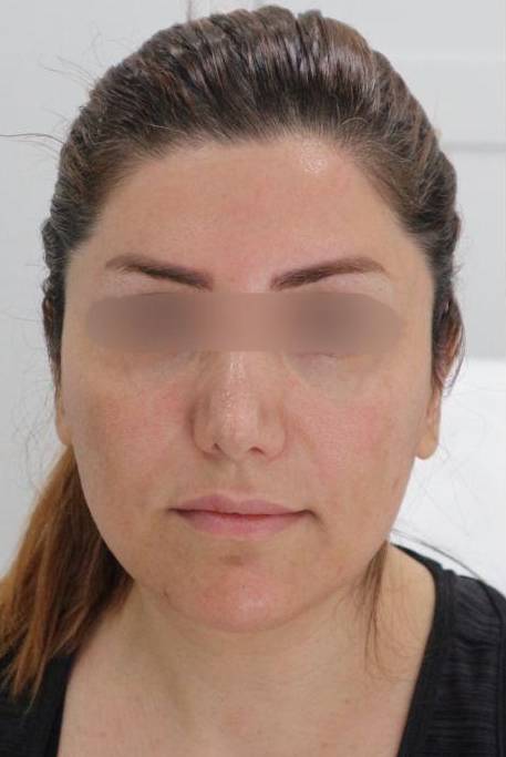 Face Slimming Case 7 After