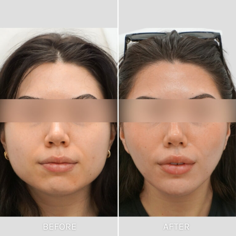 Botox Case 1