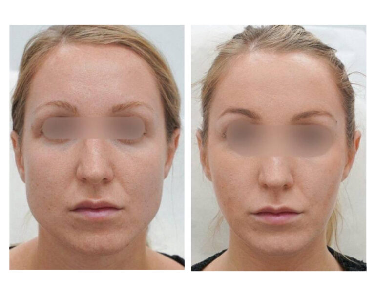 Face Slimming Case 1