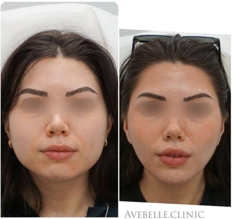 Face Slimming Case 2