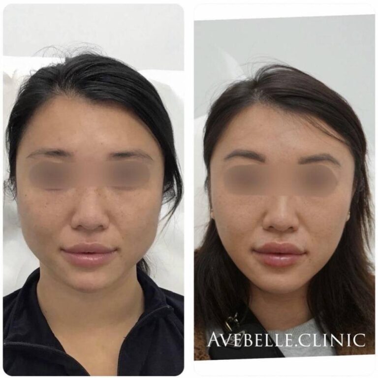 Face Slimming Case 3