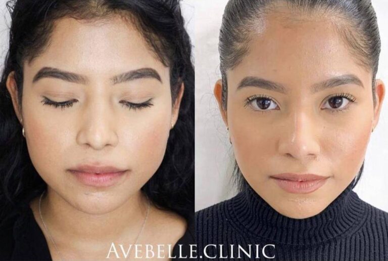 Face Slimming Case 4