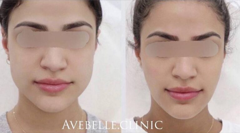 Face Slimming Case 5