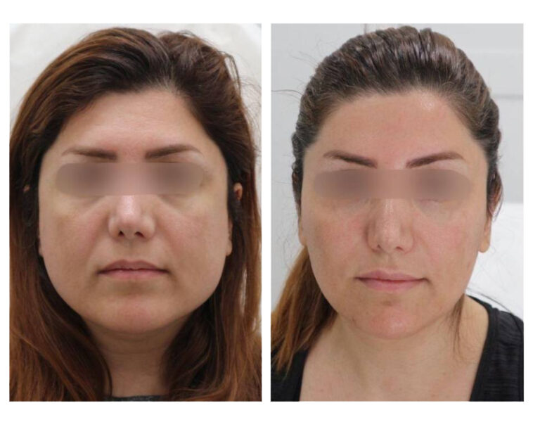 Face Slimming Case 6