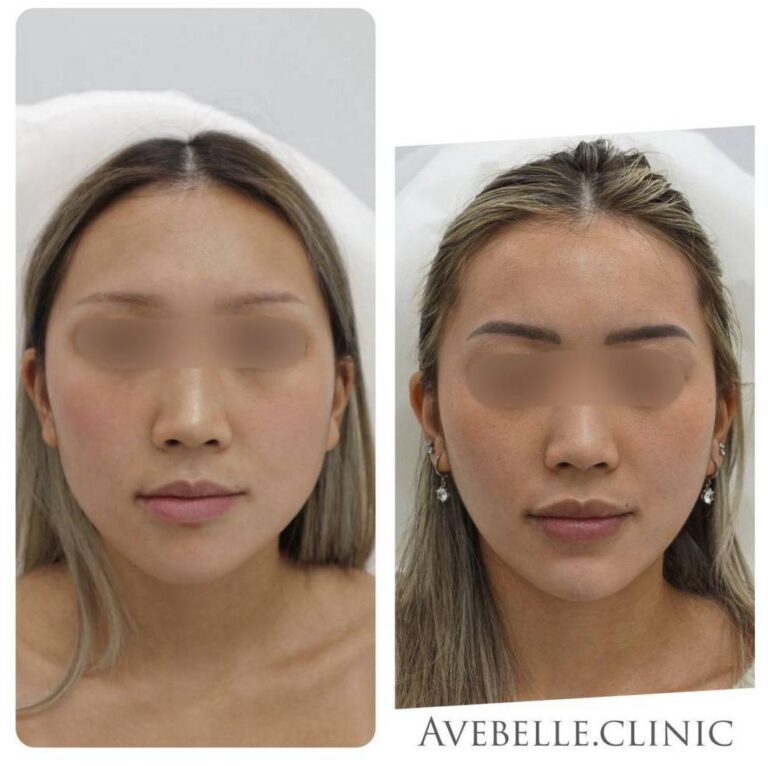 Face Slimming Case 7