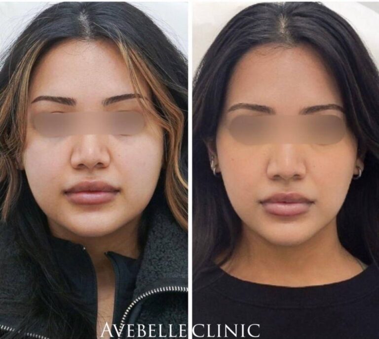 Face Slimming Case 8