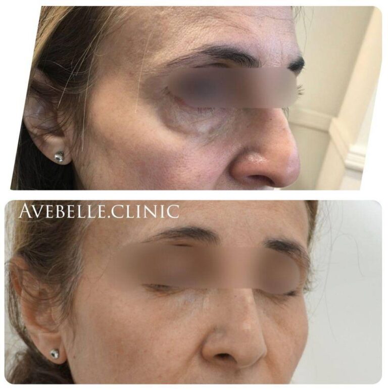 Undereyes Case 4
