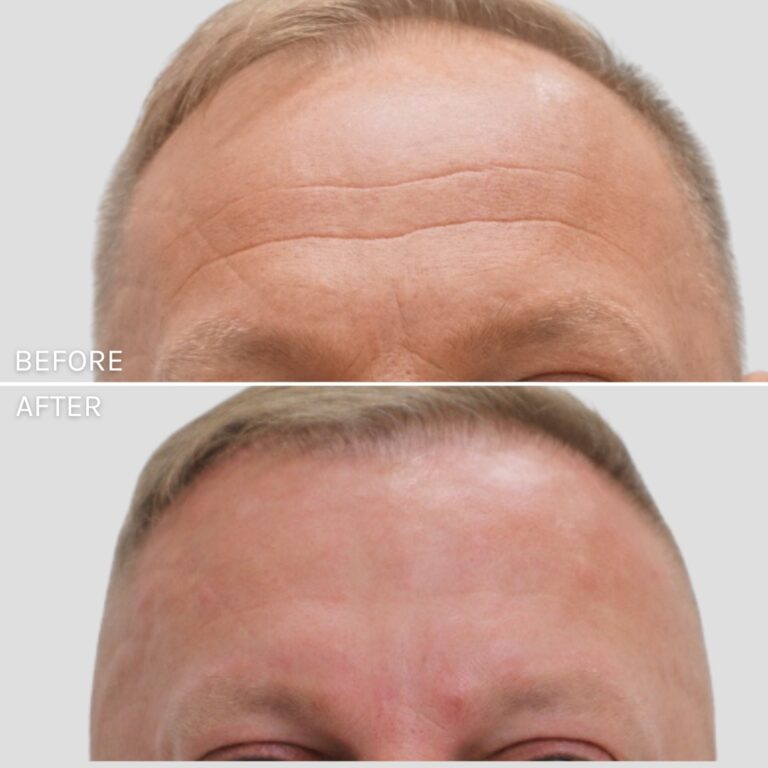 Botox Case 4