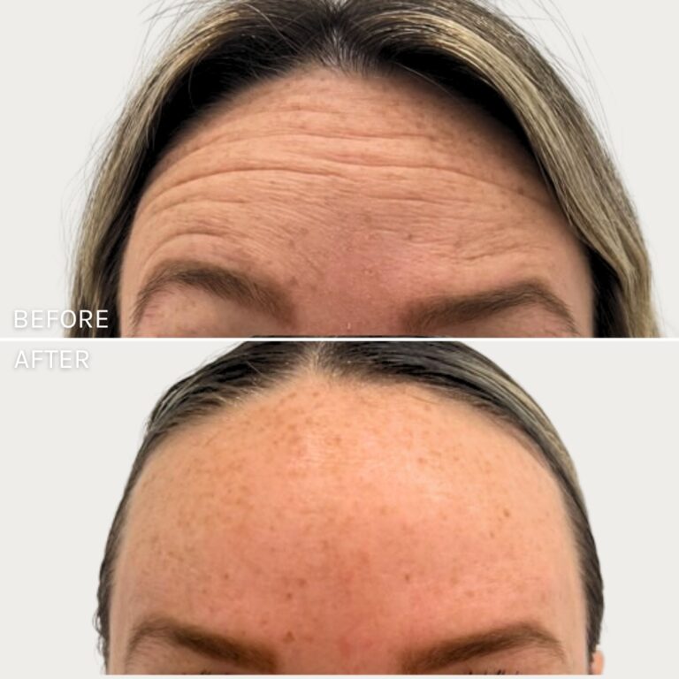 Botox Case 5